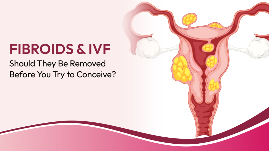 Fibroids Before IVF: When Should Fibroids Be Removed Before Trying for Pregnancy?