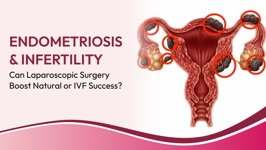 Endometriosis and Infertility: When Can Laparoscopic Surgery Improve the Chances of Natural Pregnancy or IVF Success?