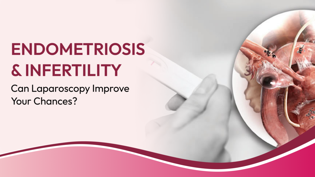 Endometriosis and Infertility: When Diagnostic Laparoscopy Can Change the Treatment Plan
