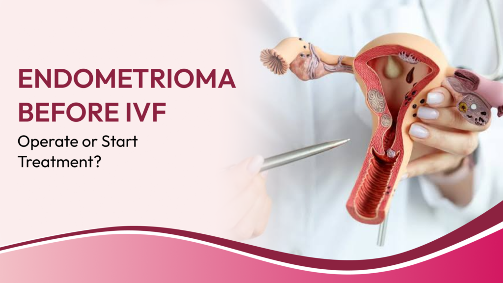Ovarian Endometrioma and IVF: When Should Surgery Be Considered Before Fertility Treatment?