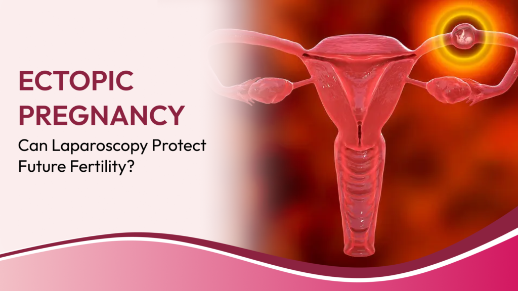 Laparoscopic Management of Ectopic Pregnancy: When Fertility-Sparing Surgery Is Possible